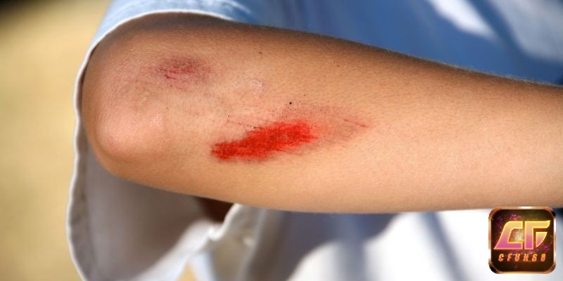 Giải mã giấc mơ thấy bị thương đánh số gì và các điềm báo liên quan