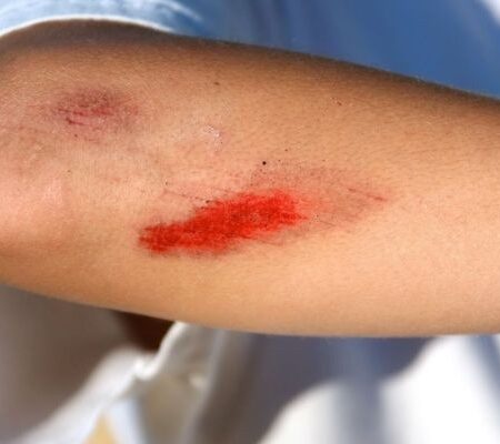 Mơ thấy bị thương đánh số gì? Điềm báo lành hay dữ?