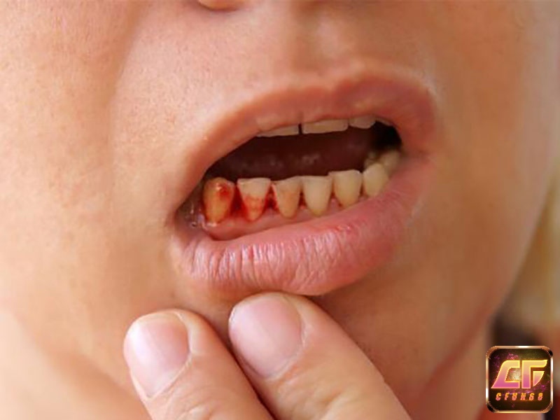Giấc mơ thấy gãy răng chảy máu thể hiện sự mất cân bằng âm dương trong cơ thể bạn