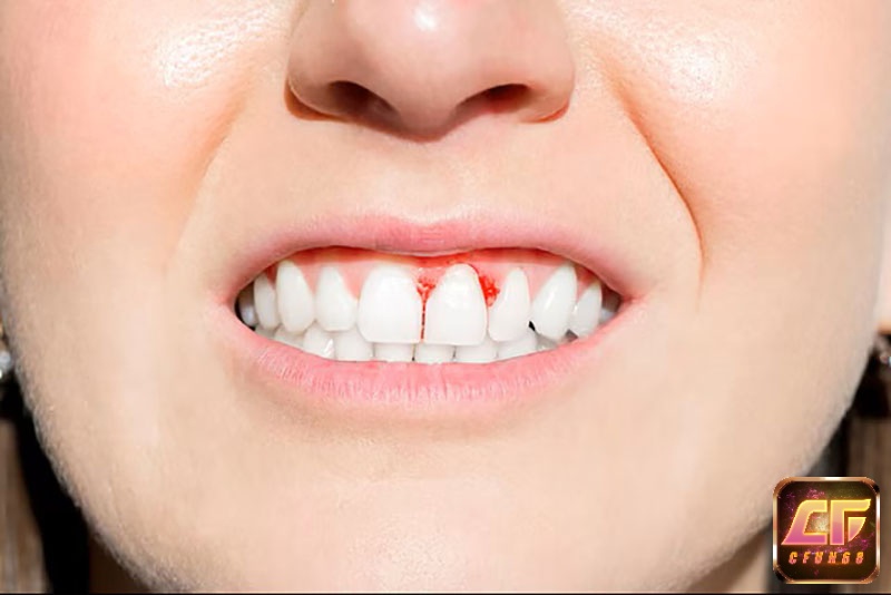 Giấc mơ thấy gãy một chiếc răng chảy máu thể hiện cho một vấn đề mà bạn đang quan tâm